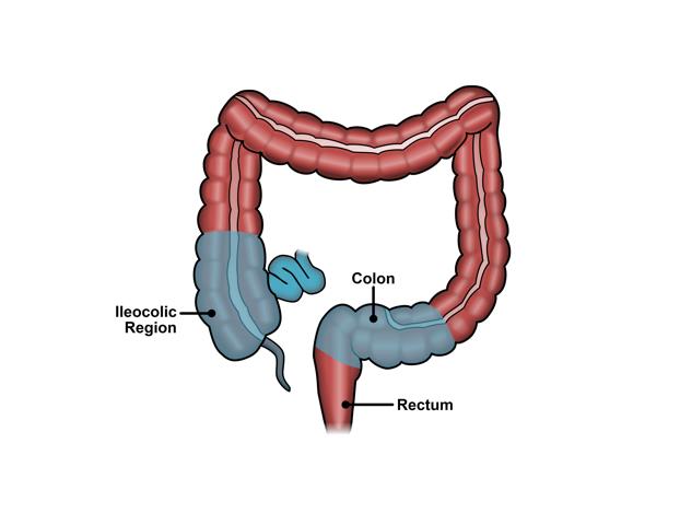 Crohn's disease